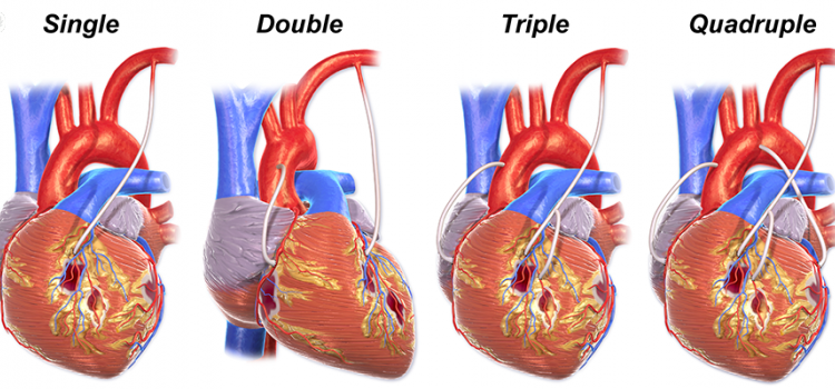 HEART BYPASS SURGERY