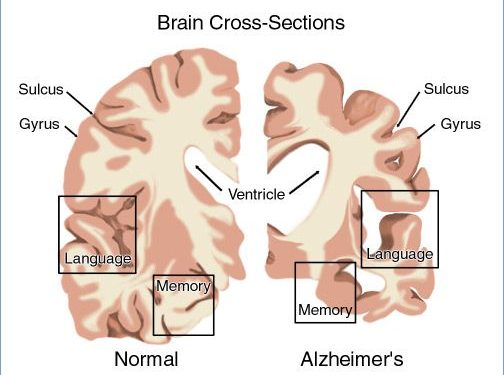 Dementia – Its Stages, Possible Cure, and Prevention Techniques