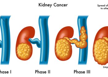 Kidney Cancer