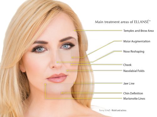 Ellanse Girl Needle Treatment for Skin Care