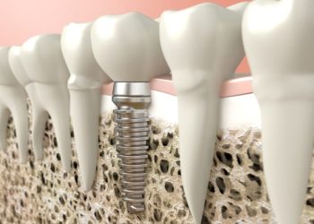 The Absolute Best Dental Implants in Los Angeles: How to Find Them.