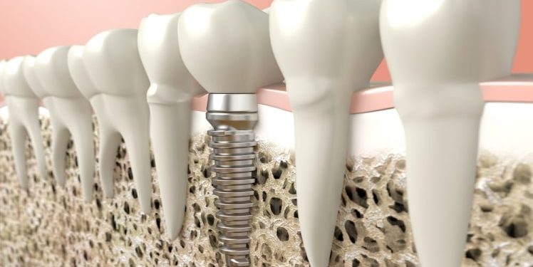 The Absolute Best Dental Implants in Los Angeles: How to Find Them.