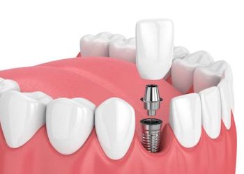 How to Finalize a Dentist in Bendigo for Tooth Implantation?