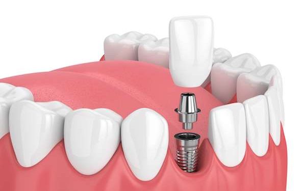 How to Finalize a Dentist in Bendigo for Tooth Implantation?