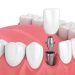 How to Finalize a Dentist in Bendigo for Tooth Implantation?