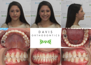 Creating Confident Smiles with Clemson Orthodontist