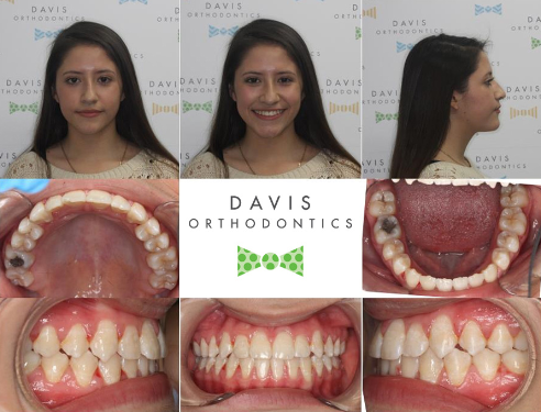 Creating Confident Smiles with Clemson Orthodontist