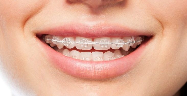 Orthodontic Treatment Options For All Ages