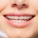 Orthodontic Treatment Options For All Ages