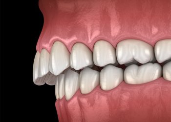 How to Treat Forwardly Placed Teeth?