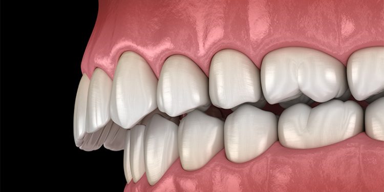 How to Treat Forwardly Placed Teeth?