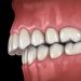 How to Treat Forwardly Placed Teeth?