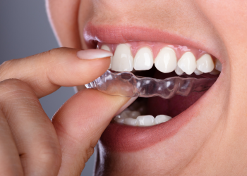 6 Benefits Of Using Invisalign Braces