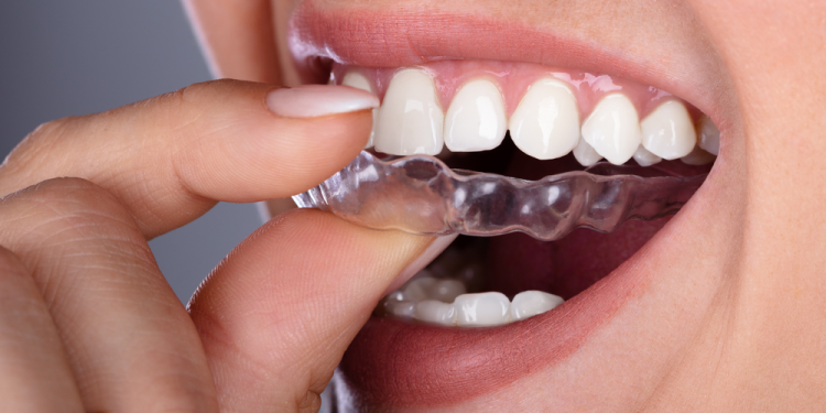 6 Benefits Of Using Invisalign Braces