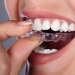 6 Benefits Of Using Invisalign Braces