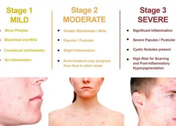 What You Need To Know About Pimple Treatments