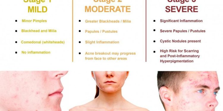 What You Need To Know About Pimple Treatments