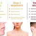 What You Need To Know About Pimple Treatments