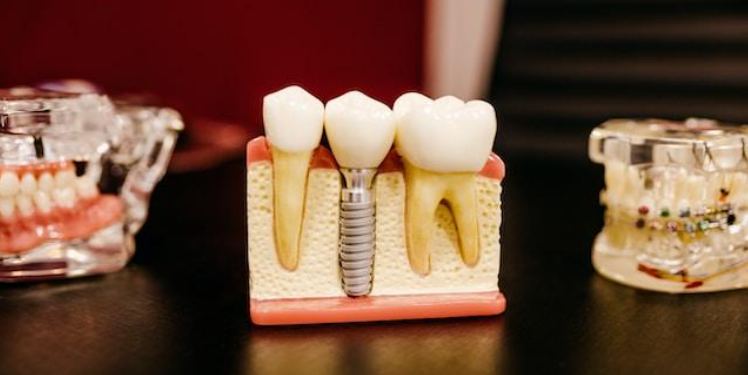 Replacing missing teeth with dental implants South Yarra