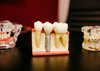 How getting dental implants in Teddington can transform your life