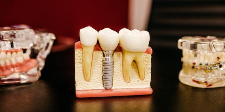 How getting dental implants in Teddington can transform your life