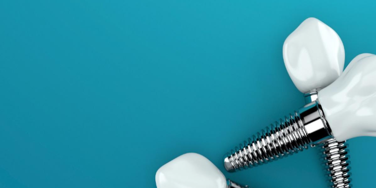 Permanent tooth replacement with dental implants Sydney