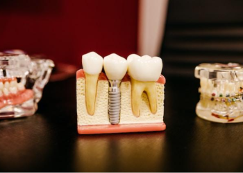 Put your teeth back in with dental implants