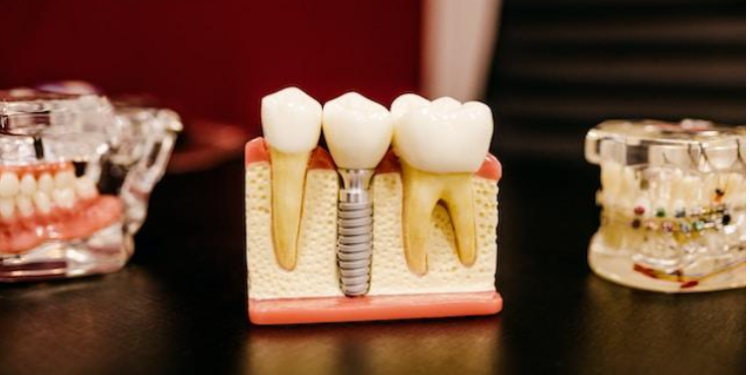 Put your teeth back in with dental implants
