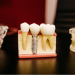 Put your teeth back in with dental implants
