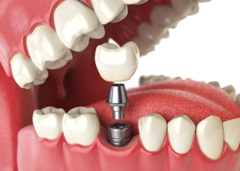 Life without dental implants