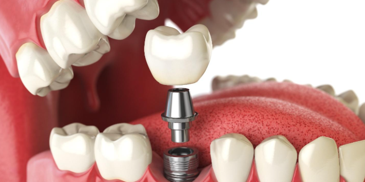 Life without dental implants