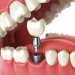 Life without dental implants