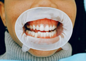 Teeth whitening Macleod for different types of stains