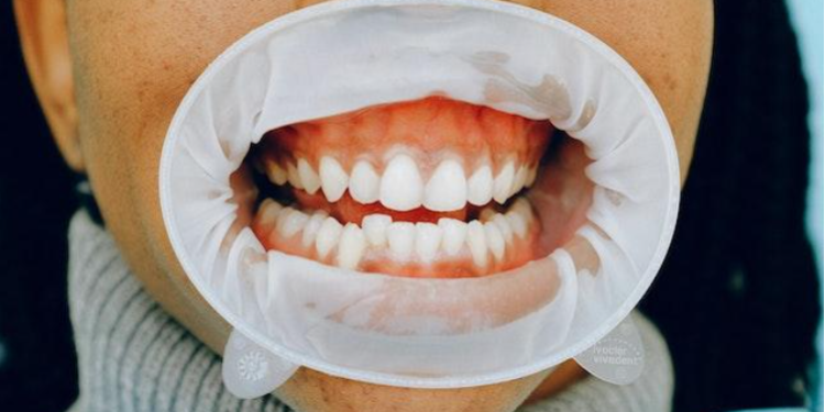 Teeth whitening Macleod for different types of stains