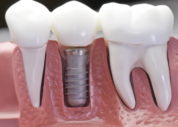 Dental implants: Why leave your mouth wanting more?