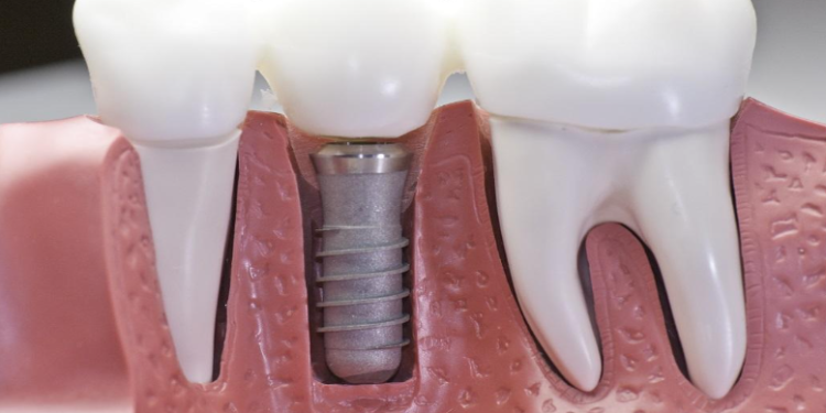Dental implants: Why leave your mouth wanting more?
