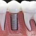 Dental implants: Why leave your mouth wanting more?