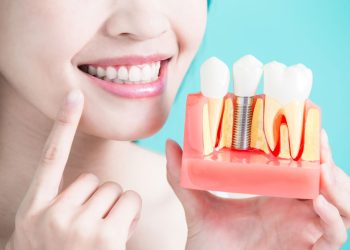 Five Tips For Dental Implant Success