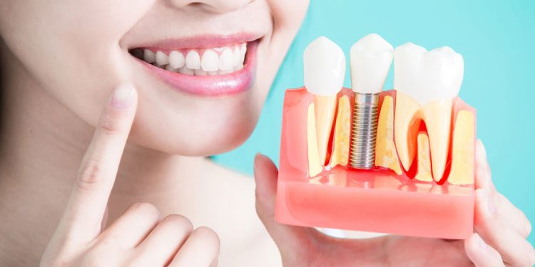 Five Tips For Dental Implant Success