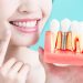 Five Tips For Dental Implant Success