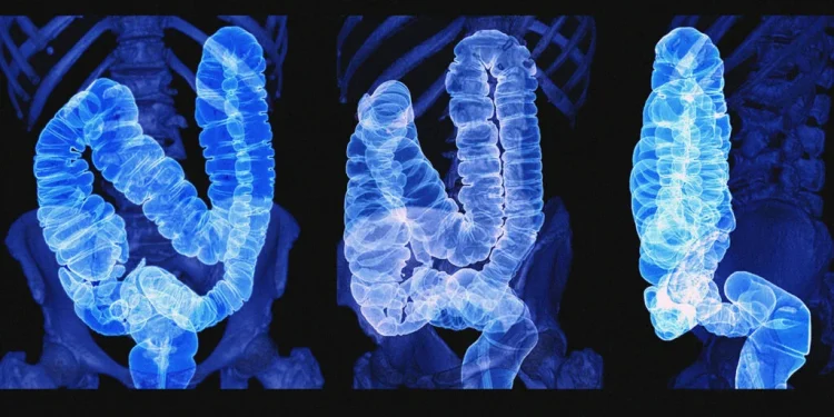 Colon Cancer: Key Facts on Causes, Risks, Symptoms, and Treatment