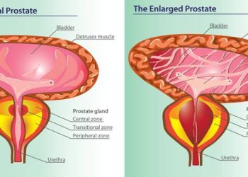 Who is at Risk of Developing Benign Prostatic Hyperplasia (BPH)?