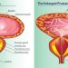 Who is at Risk of Developing Benign Prostatic Hyperplasia (BPH)?